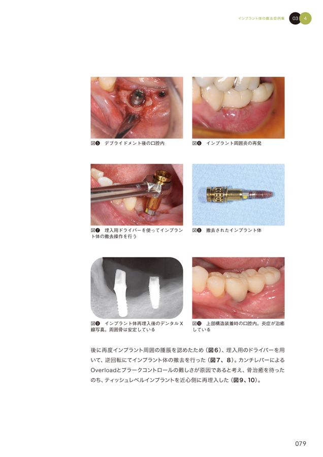 インプラントの撤去　～リスク診断から再埋入まで～ インプラントの撤去リスク診断から再埋入まで