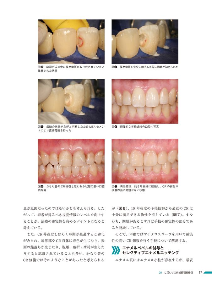 精密歯科治療 ここまできたか!マイクロスコープいろいろ活用術 精密歯科治療 ここまできたか！マイクロスコープいろいろ活用術
