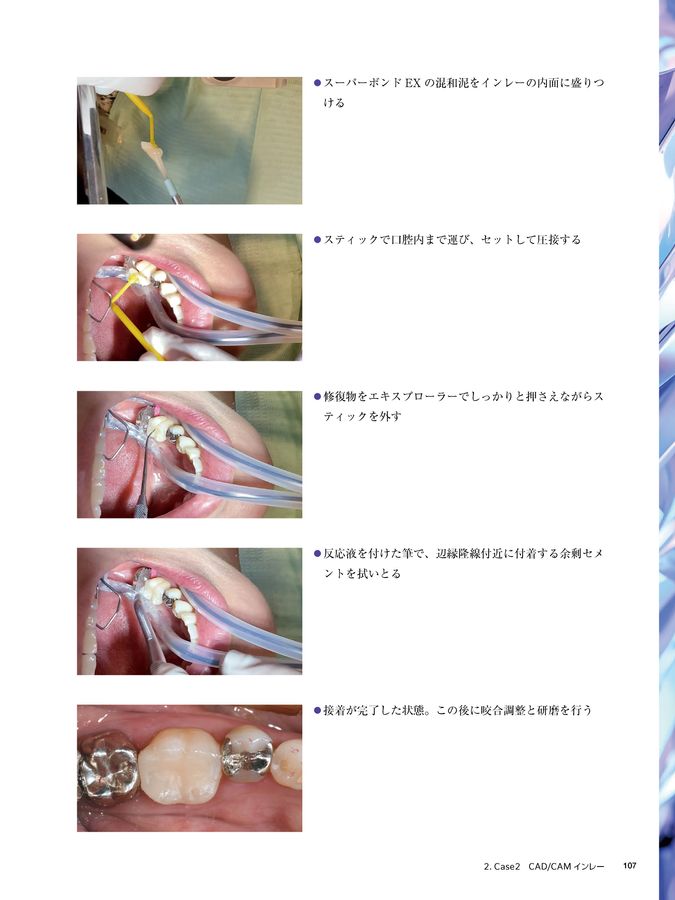 保険改定対応 CAD/CAM修復物入門 CAD/CAM冠、CAD/CAMインレー