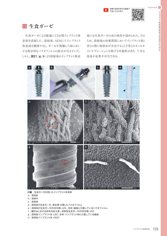 インプラント周囲疾患 診断・予防・対処法