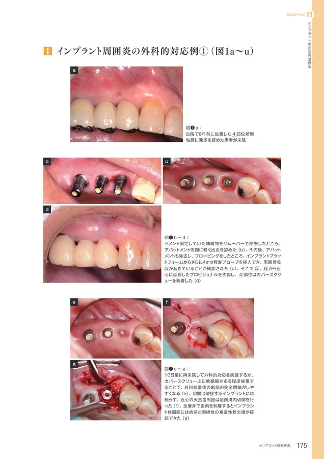 インプラント周囲疾患 診断・予防・対処法